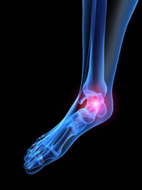 Plantar Fasciitis Foot Treatments