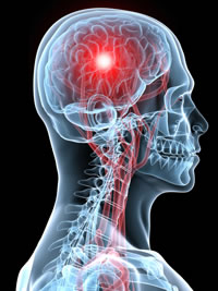 Migraine Headache