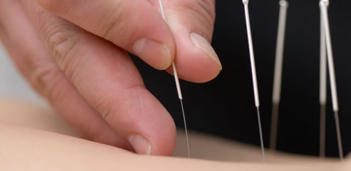Acupuncture Pain Relief